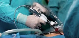 Laparoscopy